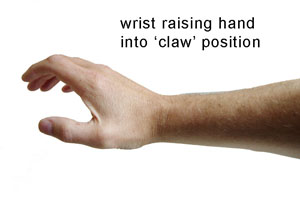 clawed_hands_rsi_sm.jpg